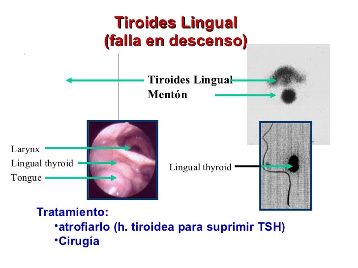 disgenesia tiroidea